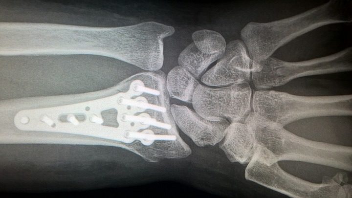 Tomar suplementos de calcio y/o vitamina D no disminuye el riesgo de fracturas.